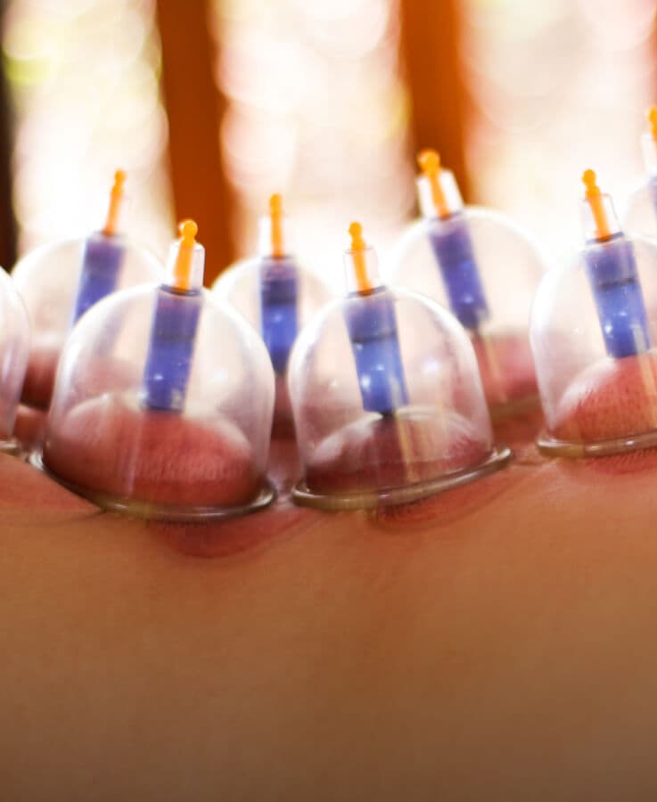 Cupping therapy treatment in session