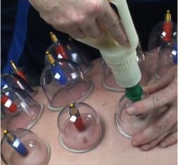 Biomagnetic Cupping