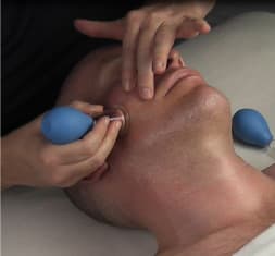 Facial Cupping
