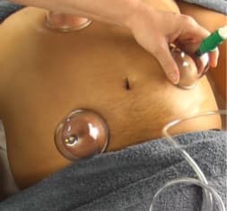 Abdominal Cupping