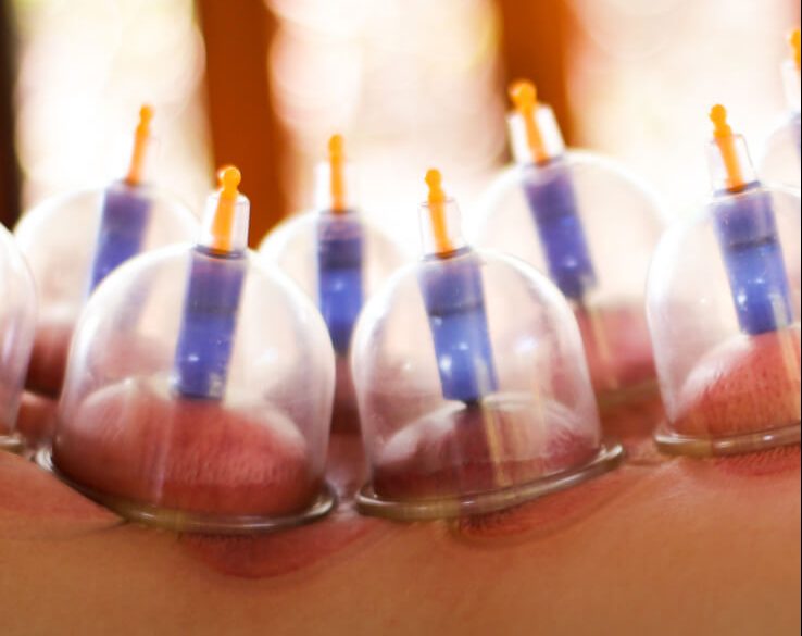 Biomagnetic Cupping