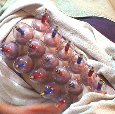 cupping